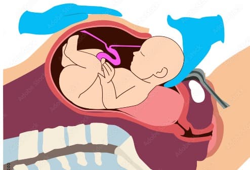 Cesarean Section (C-Section)