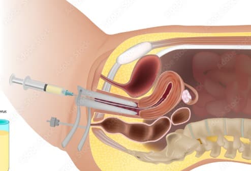 Intrauterine Insemination (IUI)