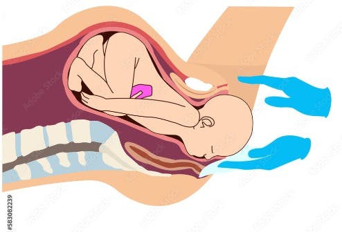 Vaginal Birth After C-Section (VBAC)