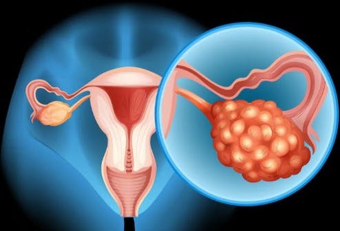 Uterine Fibroid Treatment